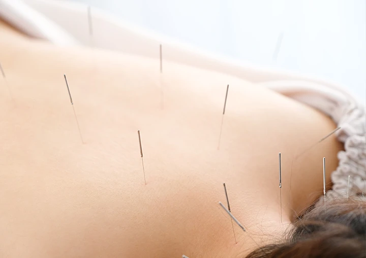 Acupuntura